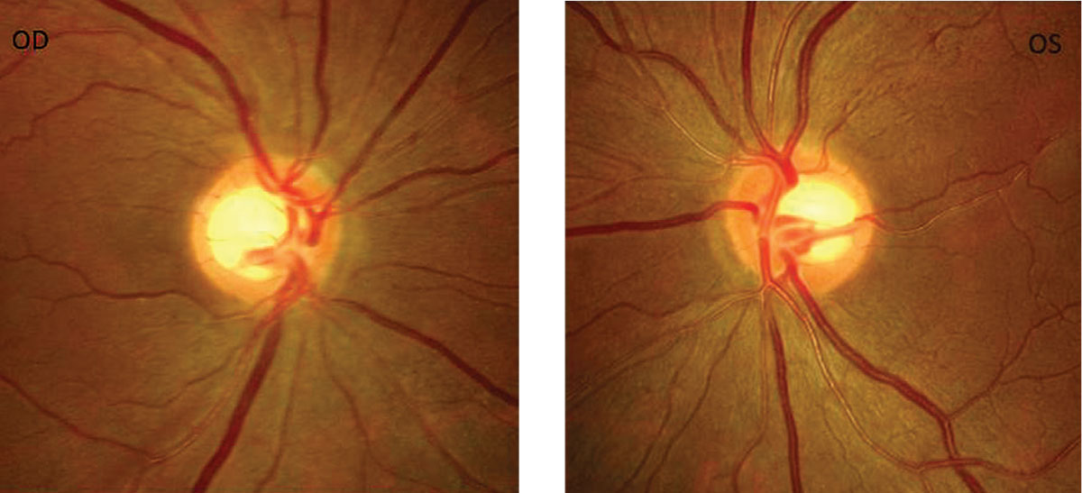 After a little roughhousing injured his eye, a patient’s near vision got progressively worse for three years. Using this history, fundus photos and a gonioscopy exam, can you help identify why he suddenly needs reading glasses? 