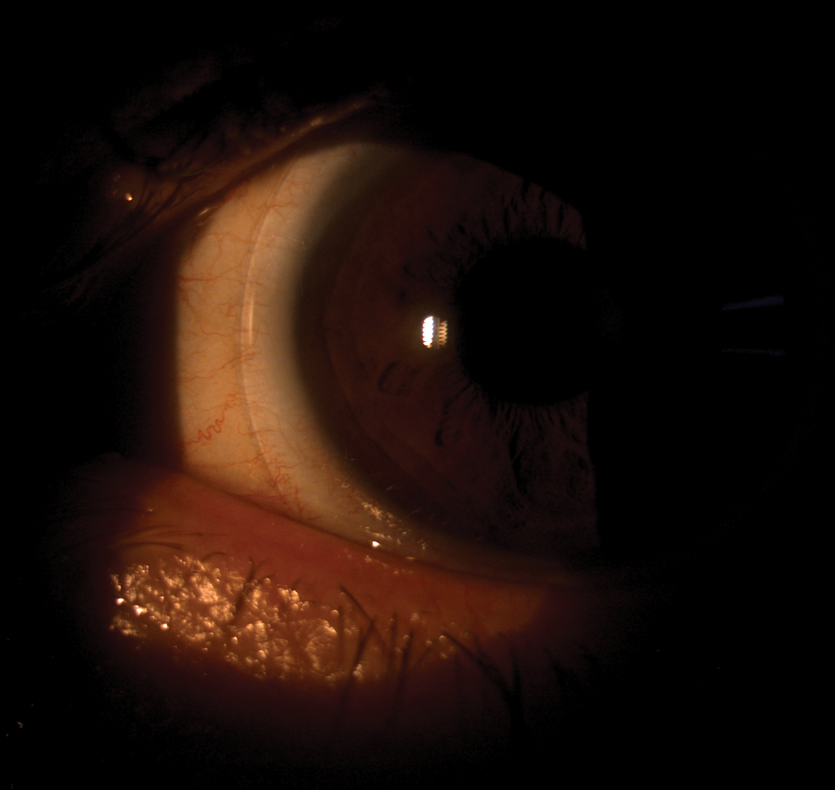 This post-LASIK patient was successfully fit with a scleral lens.