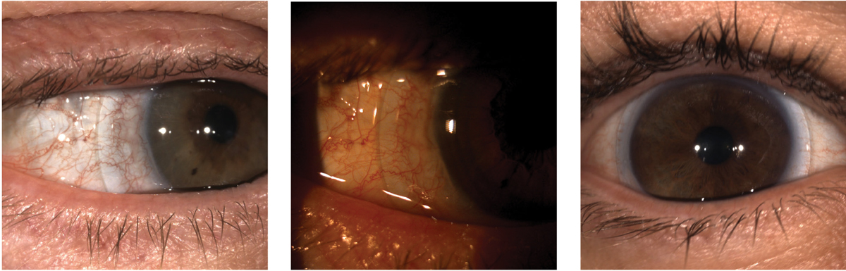 Scleral lenses with blanching at the edge, at left, or edge impingement, center, require modification to find a good edge alignment, such as the lens at right.