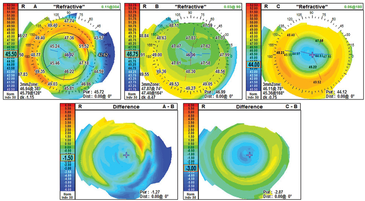 Topography is an essential tool for a specialty contact lens fitter. These refractive difference maps help illustrate ortho-K’s treatment effect. In map A, the patient is wearing a multifocal lens. Map B is the naked cornea, and map C is the same patient after a night of ortho-K.