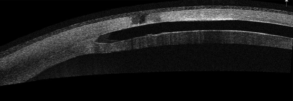 Anterior segment OCT of corneal melt over an ICRS.