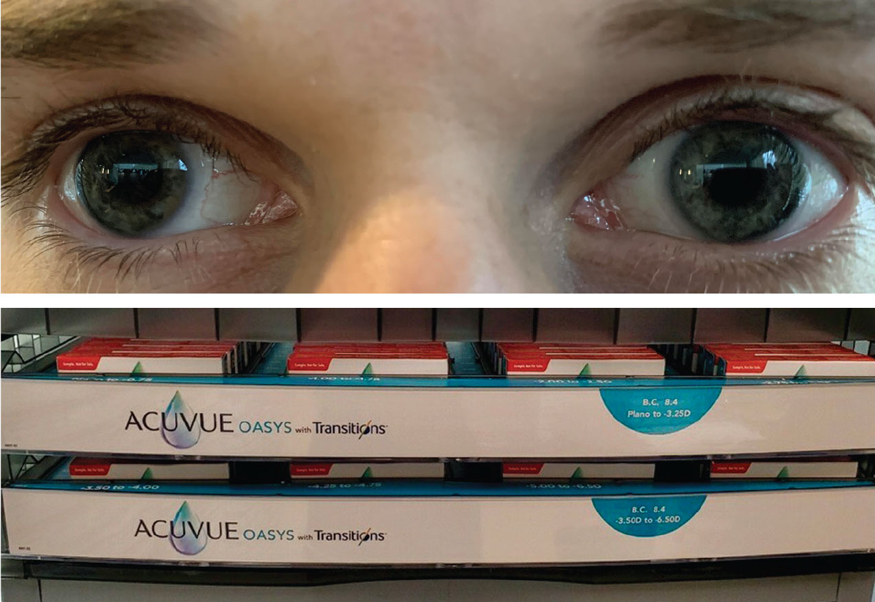 This patient who complained about eye strain from computer and digital device use did well using Acuvue Oasys with Transitions in both eyes.