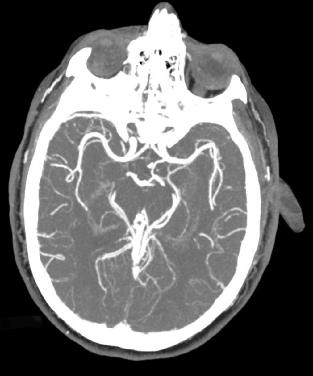 A well-timed CTA can rule out an ischemic or hemorrhagic event for your patient.