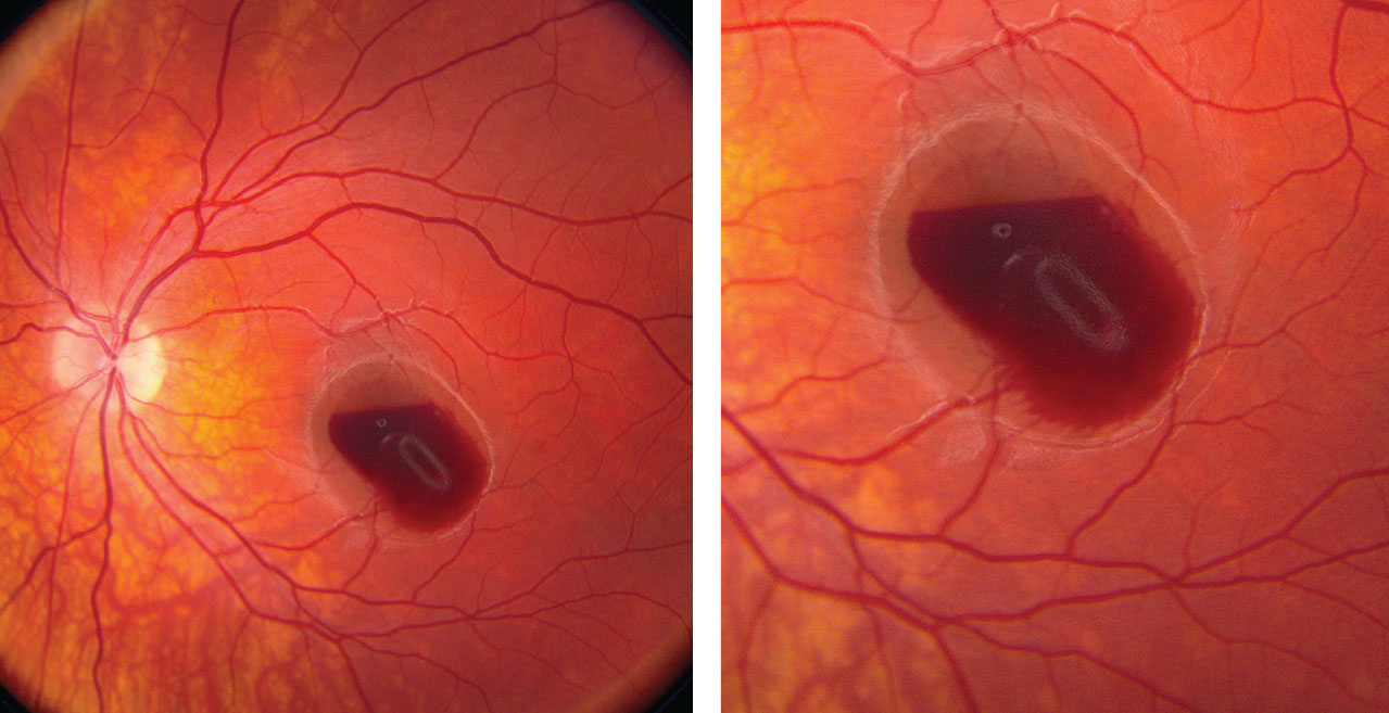 These fundus photos of the left eye show a retinal hemorrhage involving his macula. Where is the anatomic location of the blood?