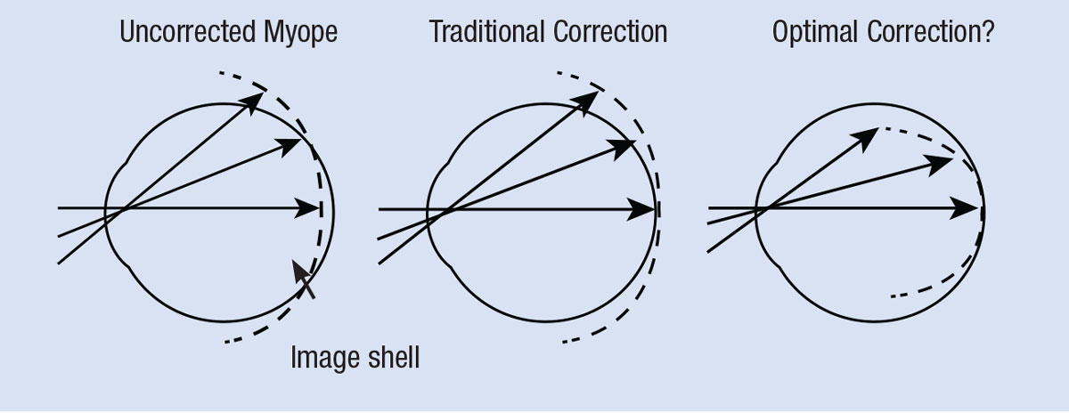 Fig. 1. This graphic illustrates myopic and hyperopic defocus, and the possible target for ideal correction. Image: adapted from Smith EL. Optom Vis Sci. 2011;88(9):1029-14.