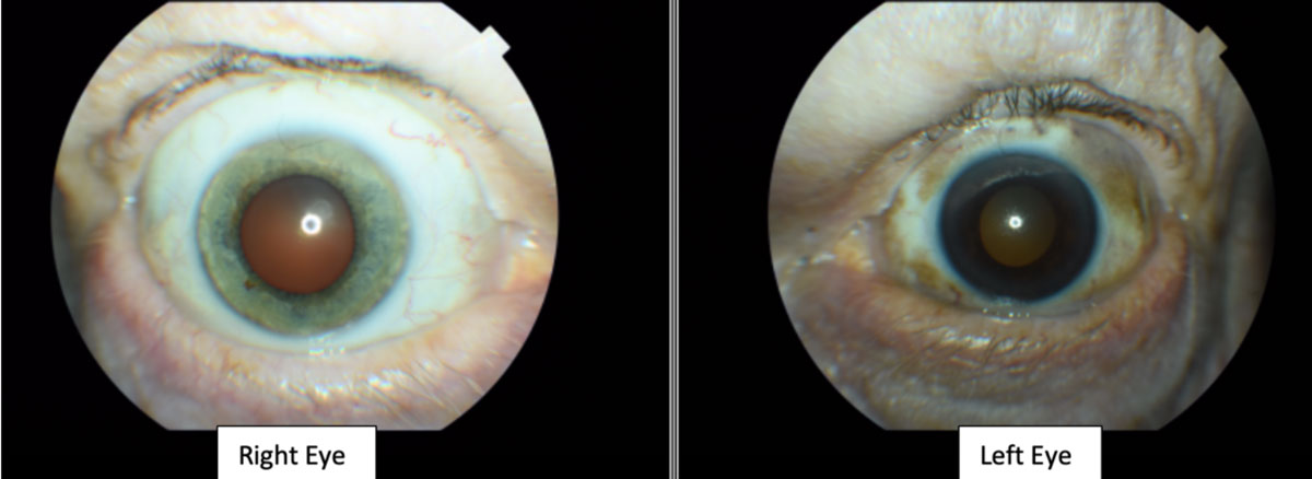 Fig. 3. The patient’s left upper and lower eyelids show visible areas of dermal pigmentation. The left temporal, nasal, superior and inferior bulbar conjunctiva also shows similar areas of pigmentation. The iris color was noted to be blue in the right eye and brown in the left eye (iris heterochromia).