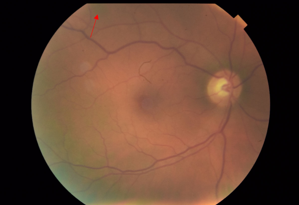 Fig. 5. Fundus photos of the right eye reveal a 0.75-disc diameter flat choroidal nevus in the superior-temporal arcade region (red arrow). The pigment appearance temporally and inferiorly is an artifact from the fundus camera. 