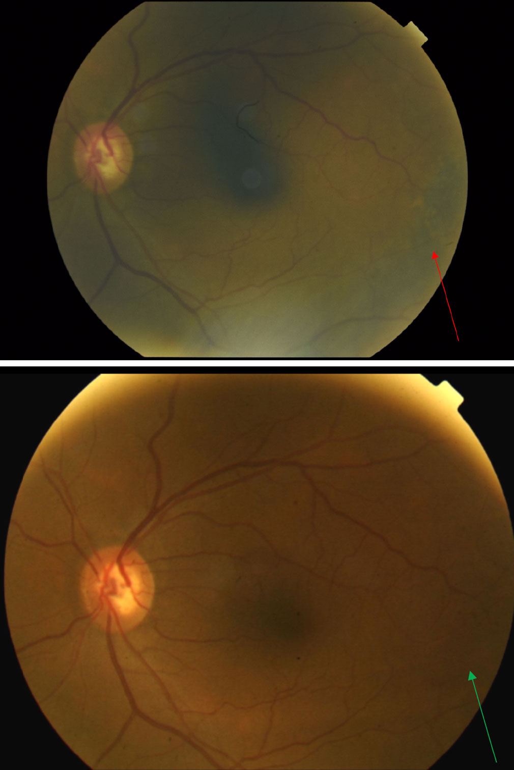 Fig. 6. Fundus photo of the left eye taken at presentation (top) reveals pigmentary changes temporal to the macula (red arrow). When compared with the fundus photo of the same left eye taken nine years earlier (bottom) one can see the progression of pigmentary changes over the years (green arrow).