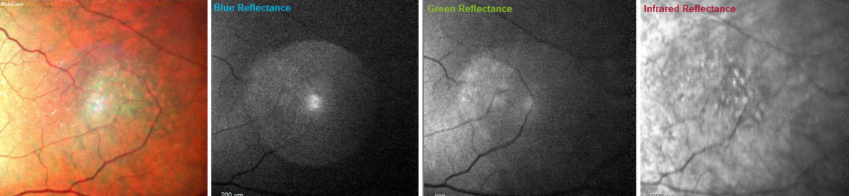 Fig. 10. With multicolor images, the orange pigment spots (far left) as well as the irregular borders (far left and far right) on the dome-shaped lesion in the left eye become more apparent. Blue wavelengths isolate the inner retinal structures (middle left); green wavelengths isolate the intraretinal structures (middle right); and the infrared wavelengths visualize the outer retinal structures, choroid and retinal pigment epithelium (far right).