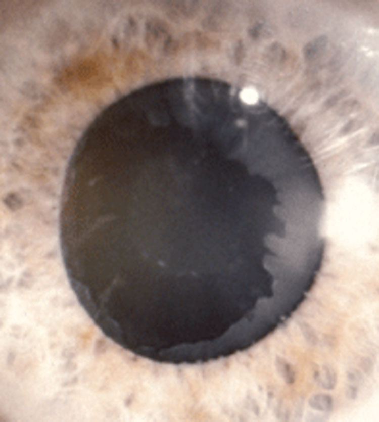 The peripupillary and lenticular fibrillar material in this PEX patient can affect dilation and cause corneal and zonule decompensation and pressure spikes.