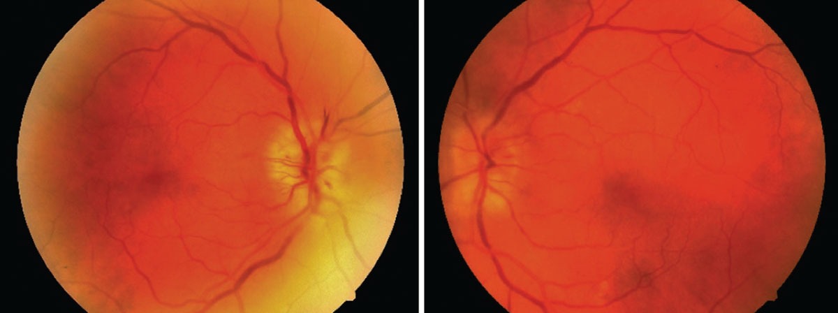 Here are the findings from the patient’s dilated fundus examination, OD on the left.