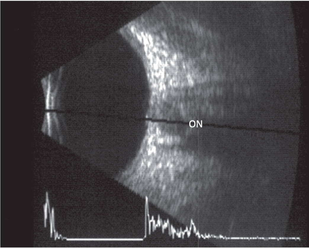 This B-scan image of a longitudinal scan includes an overlaid A-scan. The optic nerve is located in the center of the scan.