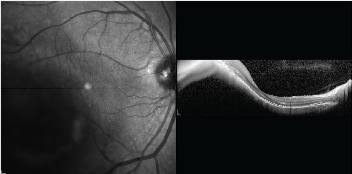 The inversion of the OCT B-scan image through a choroidal melanoma limits its utility in measuring lesion thickness.
