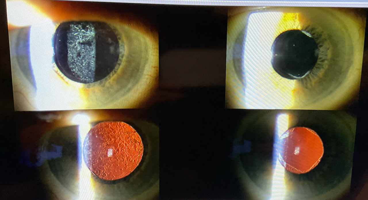 The photos on the left show the pre-op appearance of a patient with grade 3 posterior capsule opacification. The right two photos reveal the post-op appearance after a YAG capsulotomy was performed by an optometrist, showing perfect clearing of the posterior capsule. The patient’s vision was 20/20, and they were thrilled.