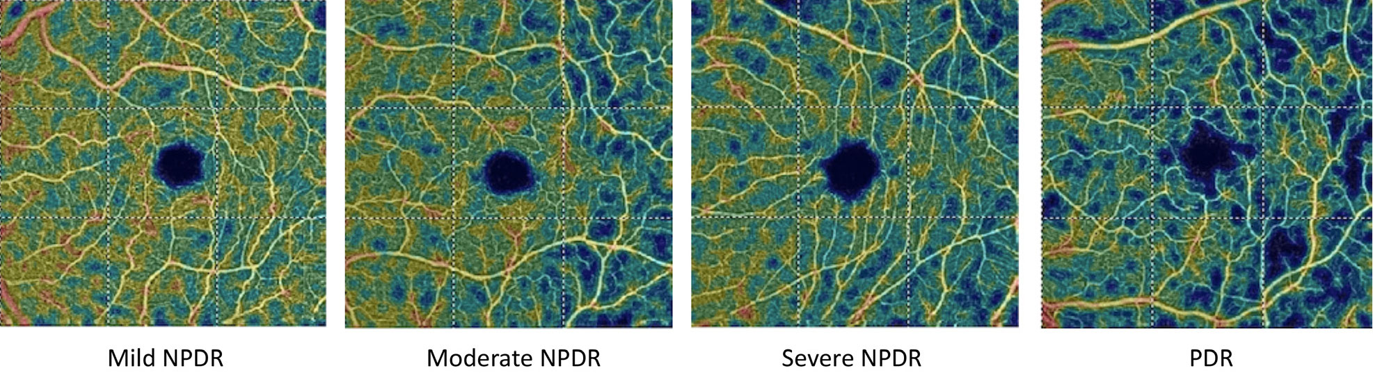 These OCT-A vessel density analysis images depict the decreased blood flow with increasing diabetic retinopathy severity.