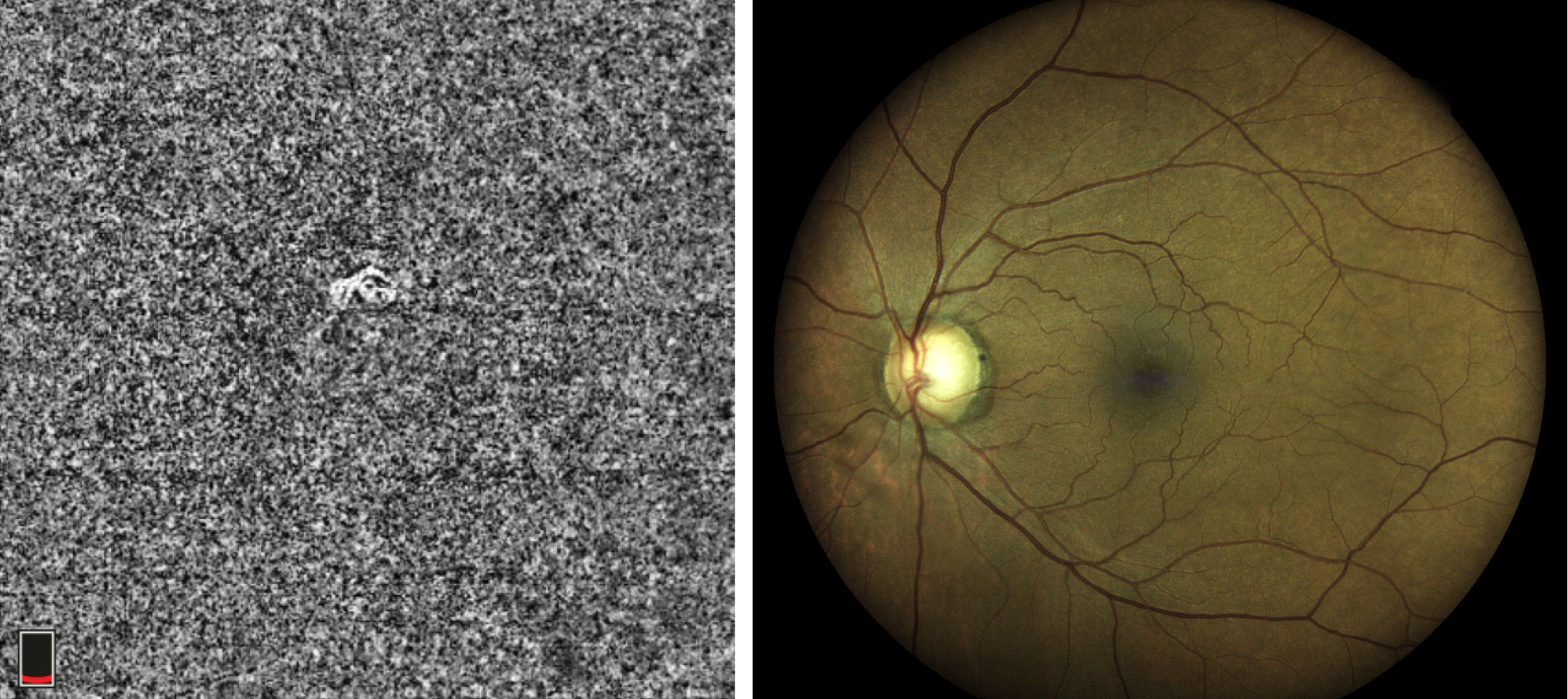 This 63-year-old African American male is a glaucoma suspect with no visible abnormality noted in the macula on fundus examination. However, the choriocapillaris slab and the B-scan with segmentation lines set at the choriocapillaris depict a non-exudative occult choroidal neovascular membrane. In this case, OCT-A identified a naïve macular lesion that was not visible clinically, allowing for timely referral and comanagement.
