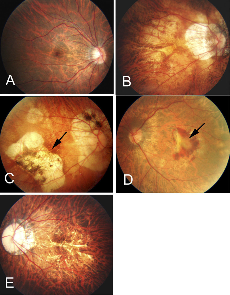 Fig. 3. (A) The tessellated fundus of a 20-year-old, -14.00D myopic woman. (B) Diffuse chorioretinal atrophy seen in a 51-year-old, -21.00D myopic woman. (C) Patchy chorioretinal atrophy and a grayish-white, well-defined lesion (arrow) in a 35-year-old, -13.00D myopic male. (D) A macular hemorrhage and fibrovascular membrane (arrow) in a 67-year-old, 10.50D myopic woman. (E) Multiple yellowish lacquer cracks in a 28-year-old, -18.00D male myope. Reproduced with permission from: Hayashi K, Ohno-Matsui K, Shimada N, et al.