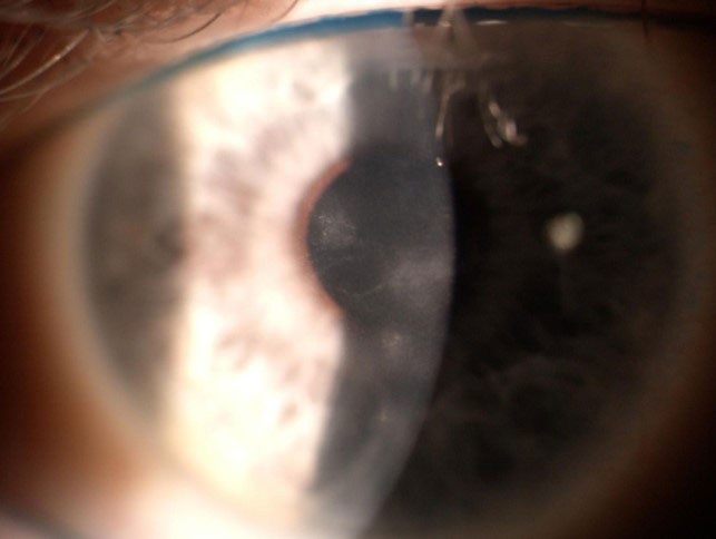Persistent opacities from past herpes simplex events are present in this eye.