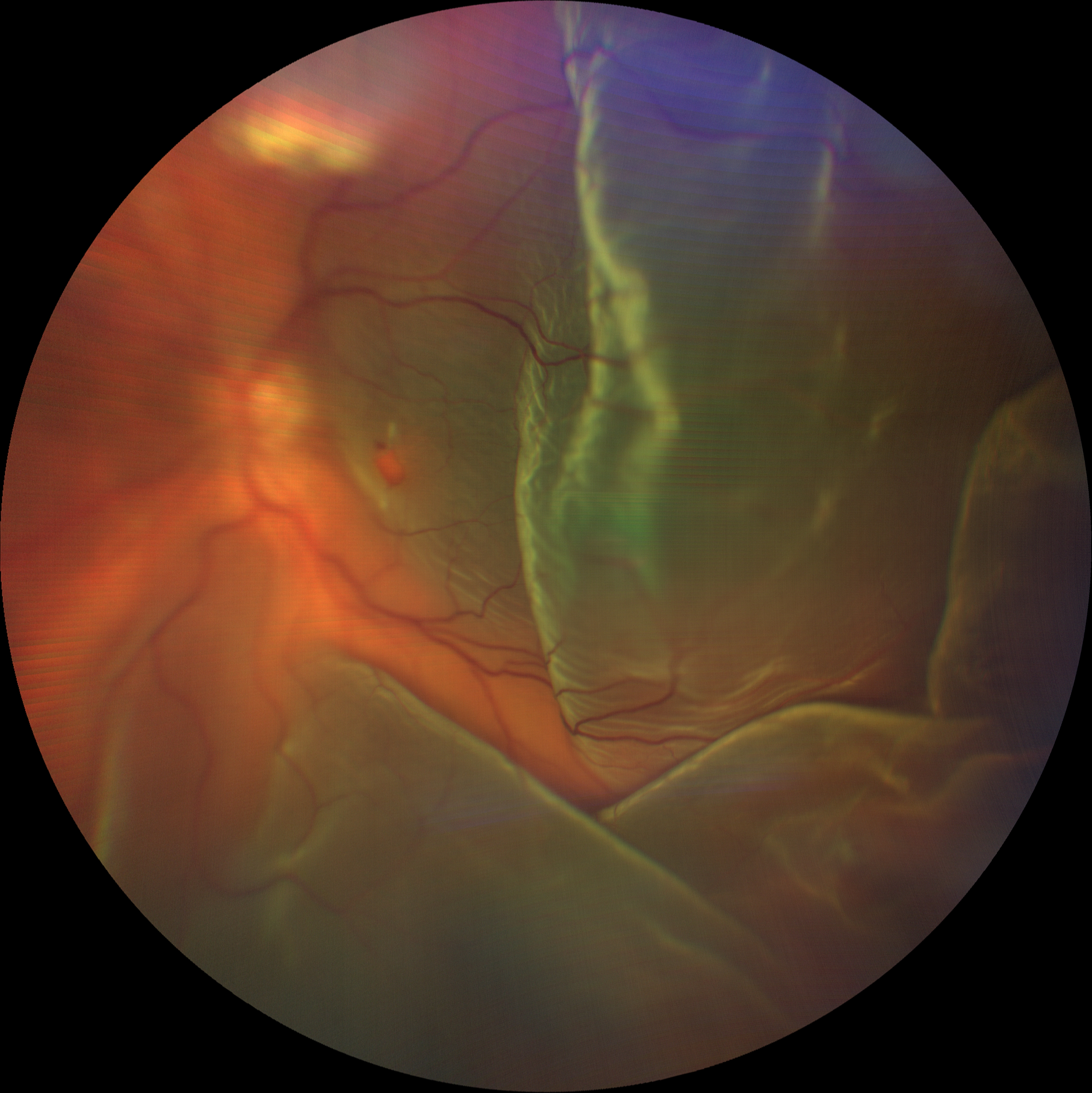 A 61-year-old Native American female was diagnosed with rhegmatogenous retinal detachment associated with macular hole in her left eye. She was referred to a retina specialist for retinal detachment repair with pars plana vitrectomy. Recurrent retinal detachment with proliferative vitreoretinopathy was noted at her follow-up visit.