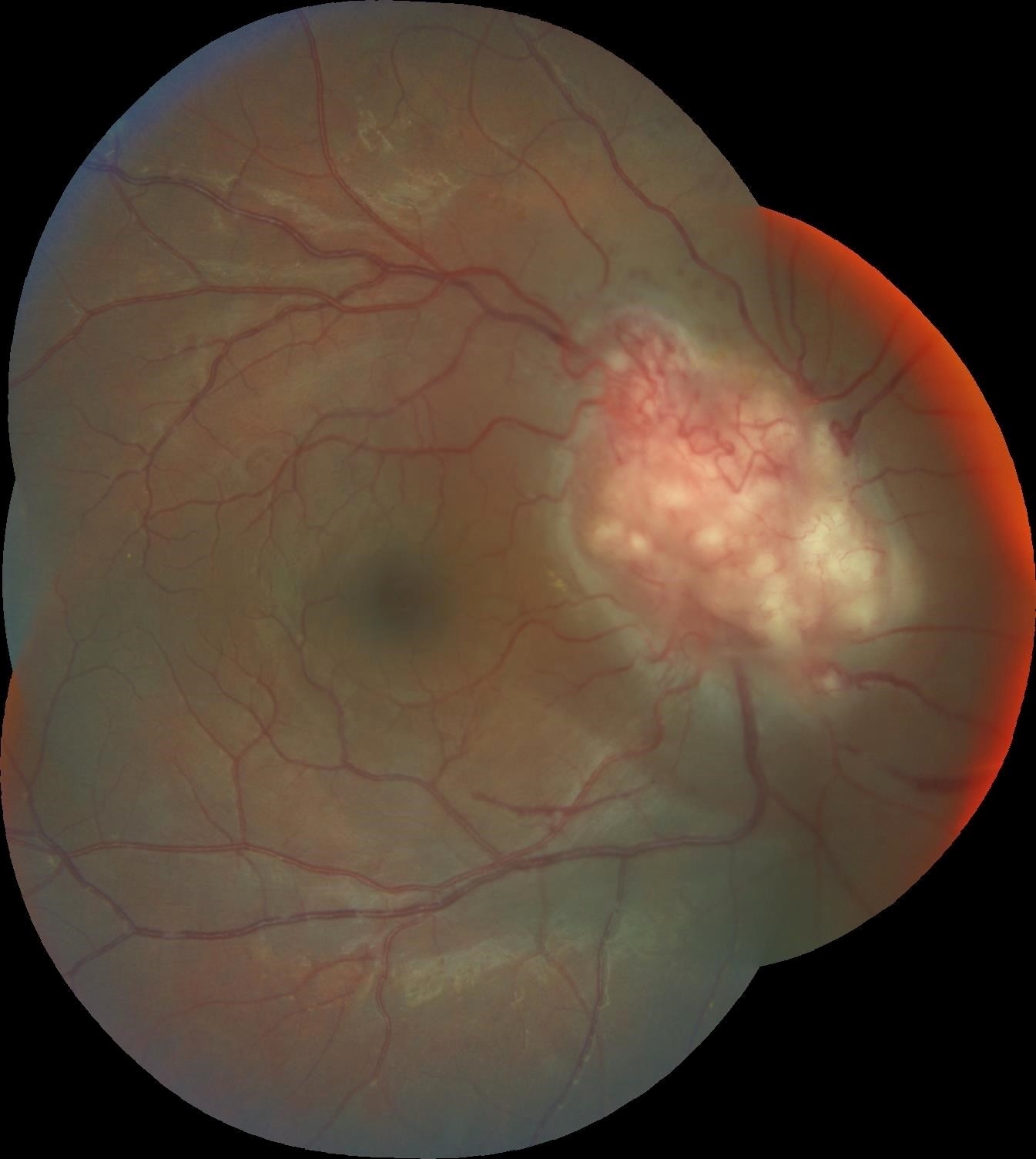 A 25-year-old African American male presented with signs and symptoms of panuveitis in the left eye. His right eye was asymptomatic, yet dilated evaluation revealed an infiltrative optic nerve head mass. Further systemic workup, including chest x-ray and MRI of the brain and orbits, revealed widespread nodular opacities throughout the lungs and brain consistent with sarcoidosis. 