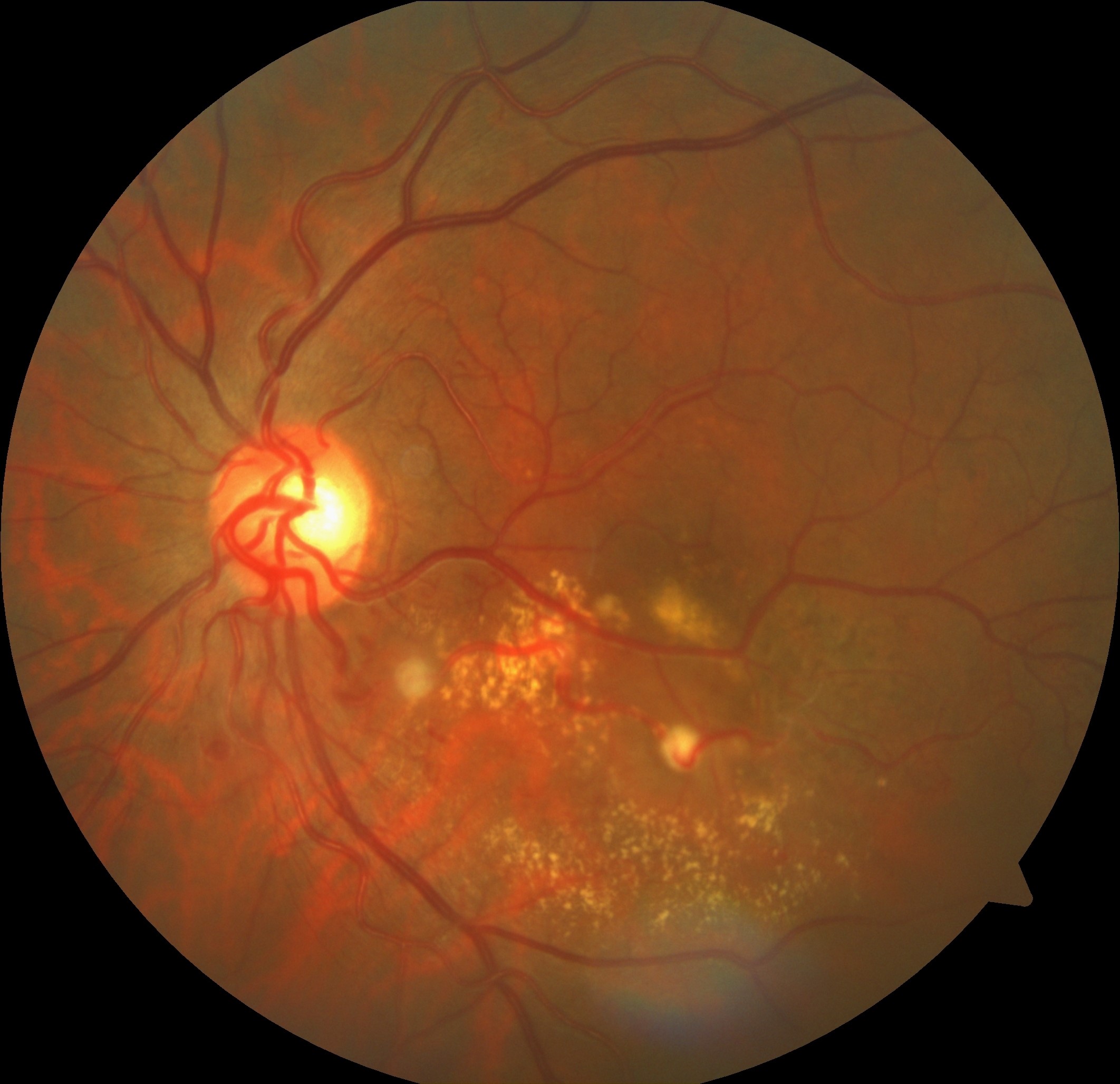 A 63-year-old male presented with acute-onset central vision loss in the left eye secondary to a ruptured retinal arterial macroaneurysm. The characteristic layers of subretinal, intraretinal and preretinal hemorrhages resorbed within three months to reveal underlying exudates, sclerotic vessels and the fibrosed aneurysm. Two additional macroaneurysms, one of which is also fibrosed, are visible in the proximal portion of the inferotemporal arcade.
