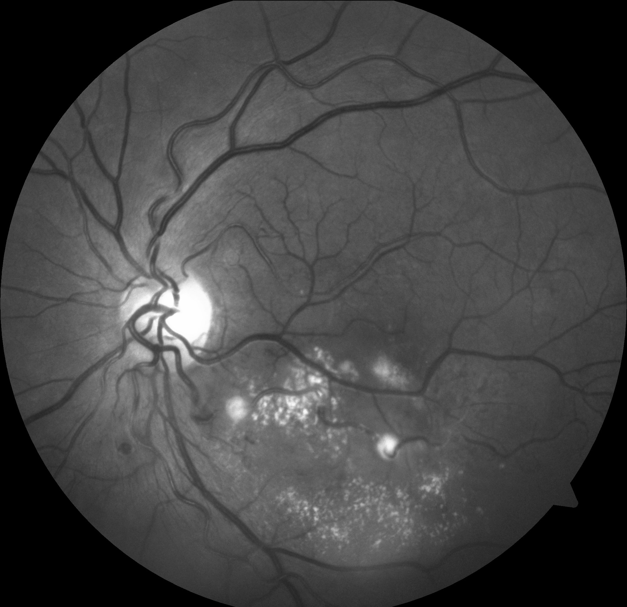 A 63-year-old male presented with acute-onset central vision loss in the left eye secondary to a ruptured retinal arterial macroaneurysm. The characteristic layers of subretinal, intraretinal and preretinal hemorrhages resorbed within three months to reveal underlying exudates, sclerotic vessels and the fibrosed aneurysm. Two additional macroaneurysms, one of which is also fibrosed, are visible in the proximal portion of the inferotemporal arcade.