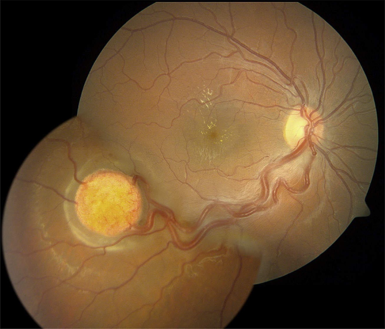 Right eye with inferior temporal solitary retinal capillary hemangioma with feeder vessels and secondary macular exudation.