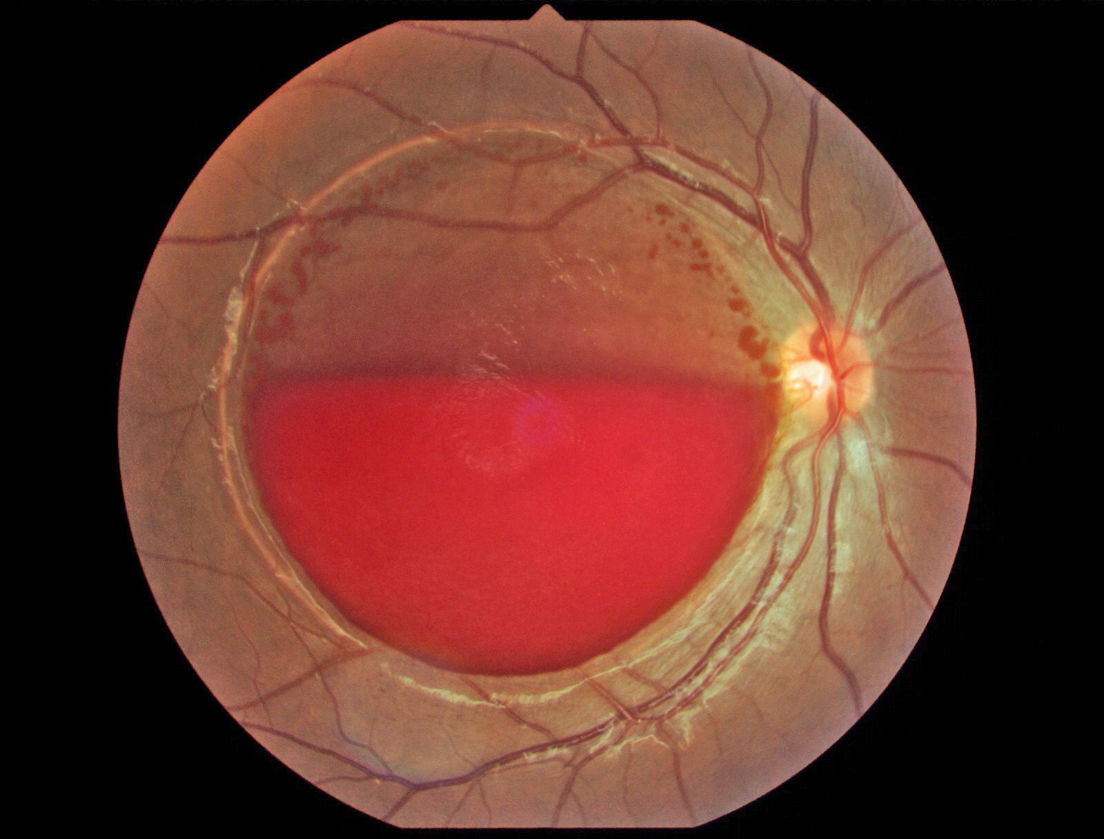 The patient presented with sudden vision loss following delivery of her baby. There is a round detachment of the ILM throughout the macula with layered blood, which resolved over a period of 20 weeks.