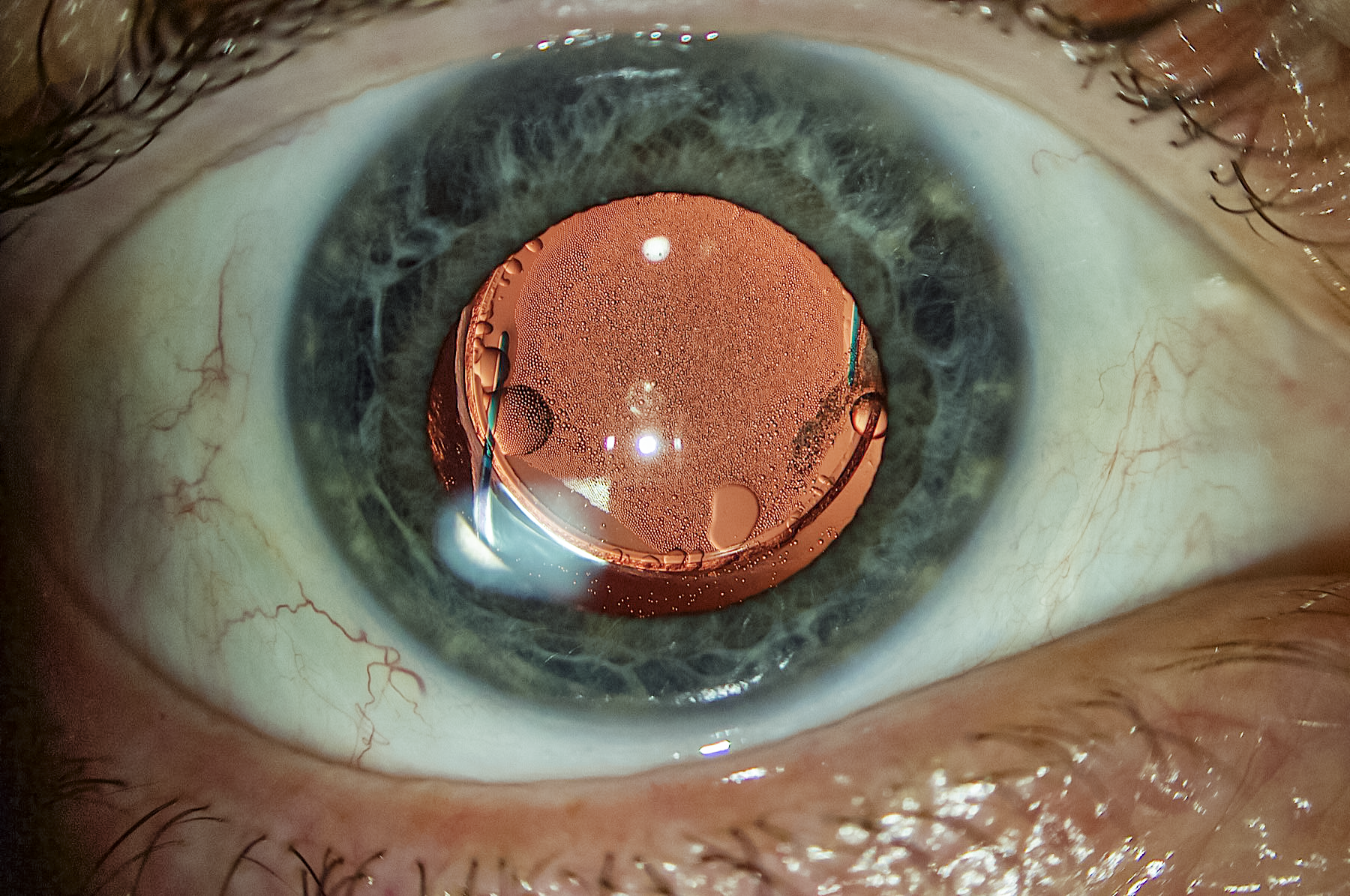 Pseudophakic patient with giant retinal tear requiring silicone oil tamponade. The oil that was adherent to the PCIOL after removal from the vitreous cavity was easily aspirated from the IOL and capsular bag. 