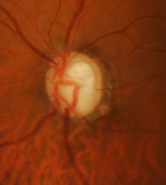 This patient has advanced disease OS. Late-stage glaucoma is associated with substantially worse quality of life.