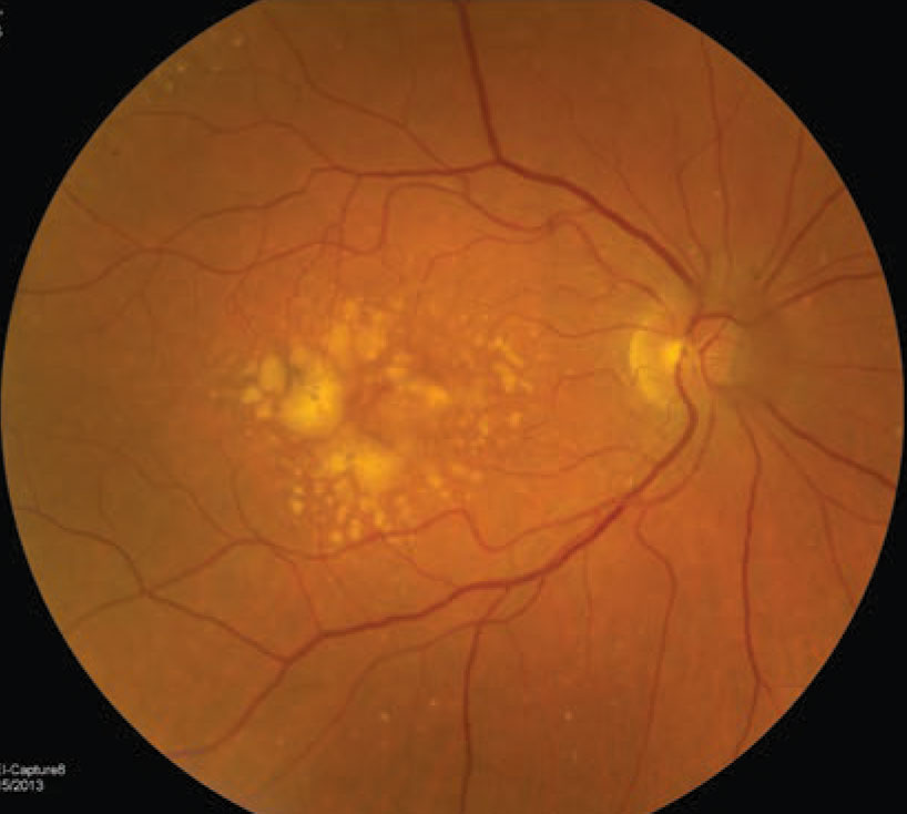 The right eye of a 72-year-old white woman who has intermediate AMD with evidence of large drusen, drusenoid pigment epithelial detachment and hyperpigmentary changes. Based on the patient’s fundus photographs, we know the risk of developing late AMD, either neovascular and geographic atrophy, is as high as 50% in five years. 