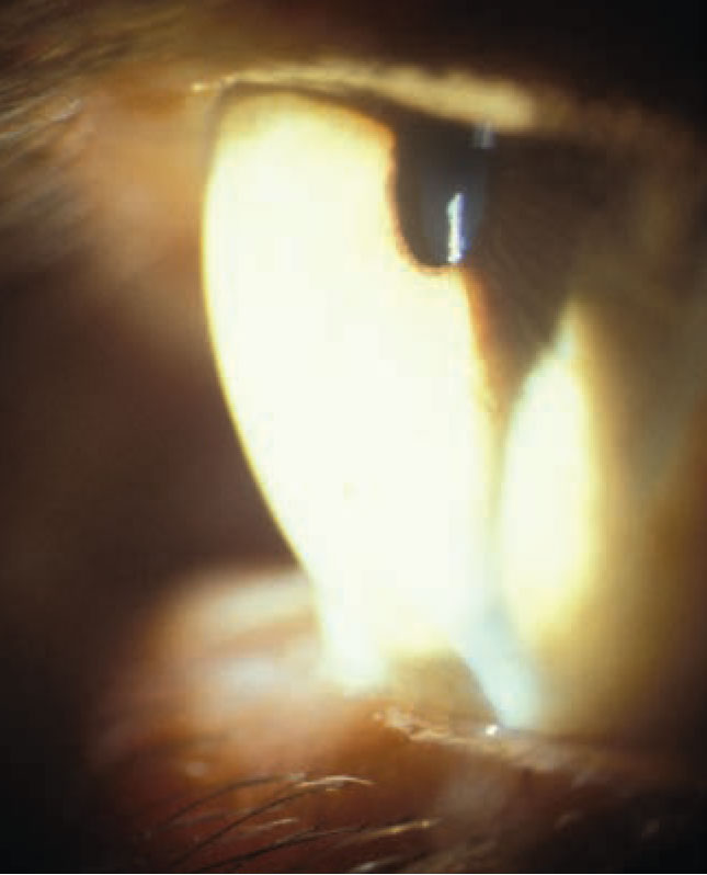 Cornea steepening in a patient with keratoconus.