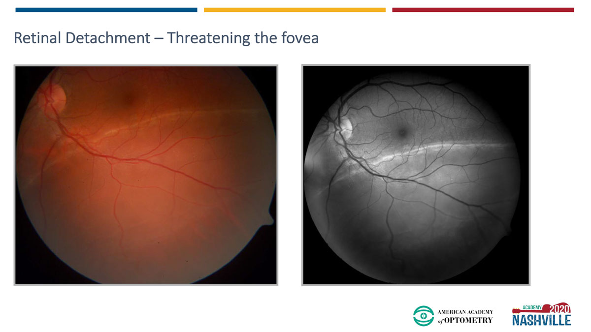 Dr. Pelino’s 29-year-old patient with high myopia presented with a complaint of superior vision loss. The dilated fundus exam revealed a retinal detachment threatening the fovea—a true emergency. 