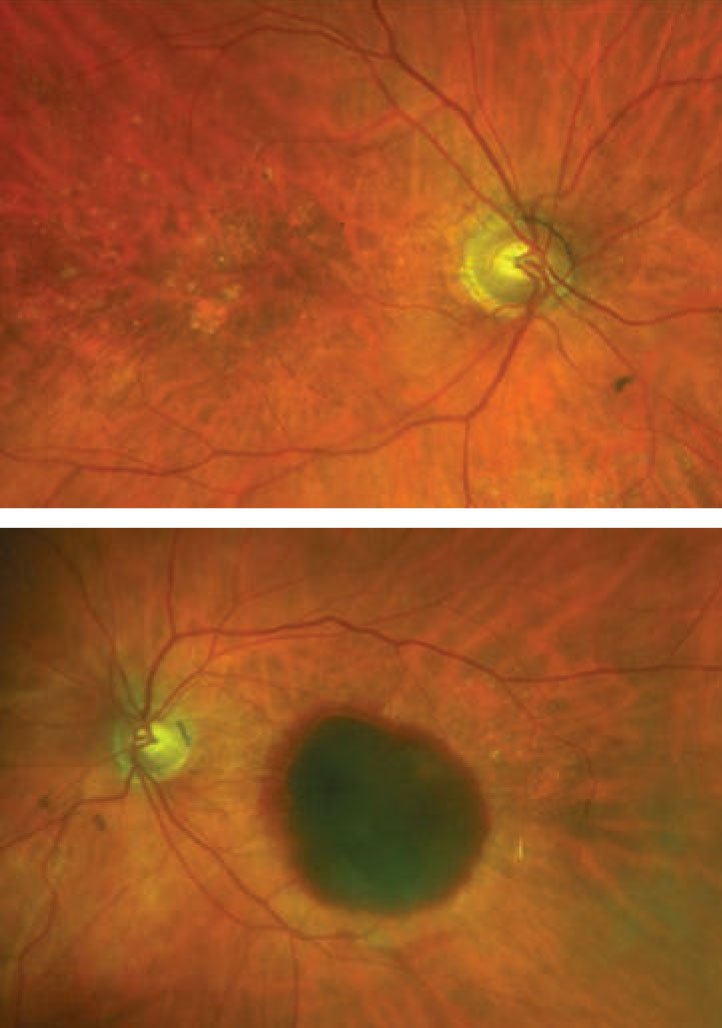 Fig. 1. In these photos of the right (top) and left (bottom) eyes, where is the blood located?