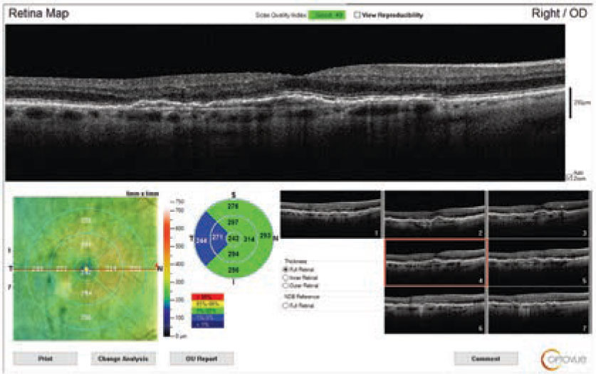 Fig. 2. What can you see in this SD-OCT of the right eye through the macula?