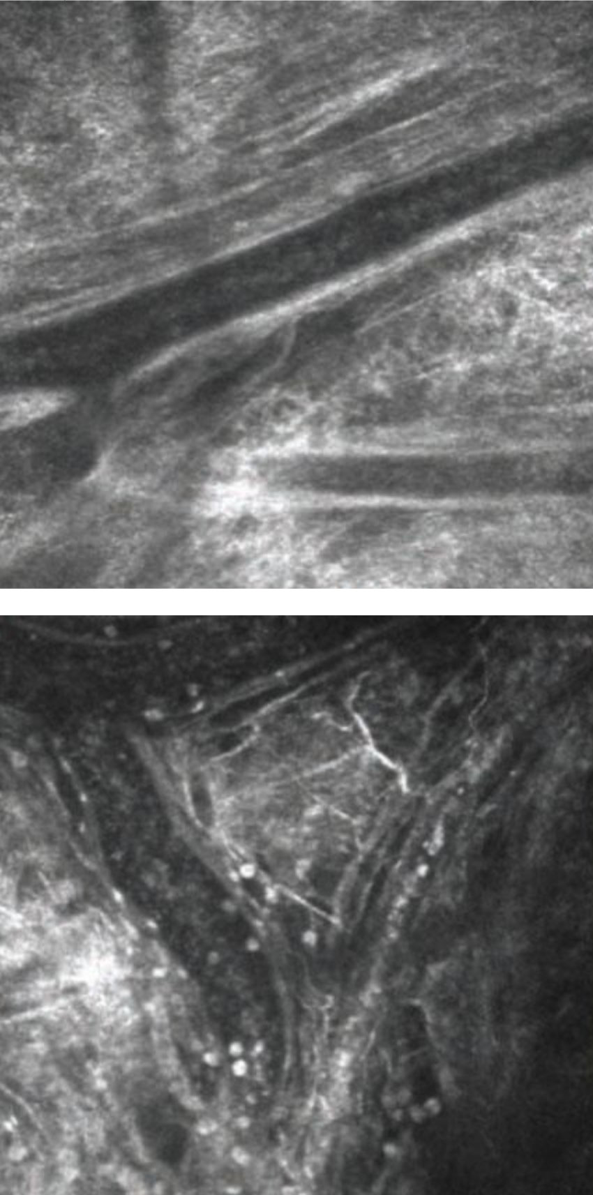In vivo imaging of conjunctival blood vessels before (left) and after (right) allergen challenge. White cells are clearly visible following challenge, and some of these can be see migrating out of vessels into extravascular space. Photo: Mark B. Abelson, MD, CM