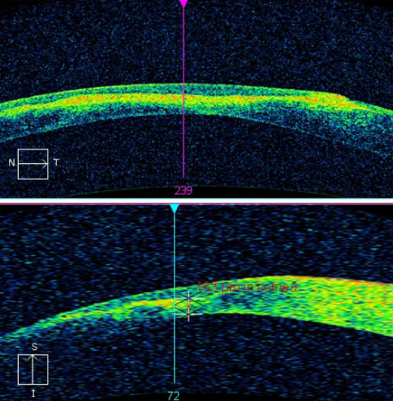 This AS-OCT scan of a 28-year-old Asian patient with advanced keratoconus and moderate-to-severe pain demonstrates intact endothelial and posterior stromal layers while showing increased reflectivity associated with stromal scarring. In this case, AS-OCT confirmed an intact endothelium and Descemet’s membrane. As an added advantage, corneal thickness was measured accurately at the thinnest location using the caliper tool, thereby providing a reliable baseline for follow-up comparison. In light of the anatomical state of the cornea, the patient’s symptoms were attributed to epithelial disruption overlying the apex of corneal steepening. Photo: Carolyn Majcher, OD