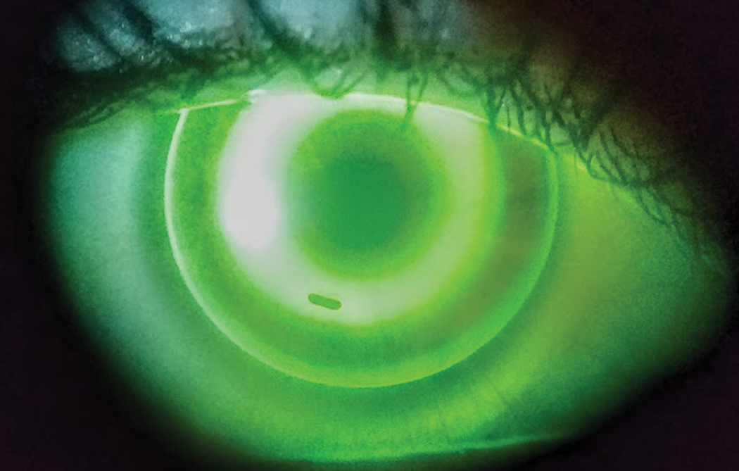 Fig. 2. In this well-centered ortho-K lens at the initial visit, note the small bubble under the return zone inferiorly. These can be ignored and will generally dissipate as the reshaping occurs in the first 24-hour period. You could also instruct the patient to overfill the lens with a viscous artificial tear prior to insertion.