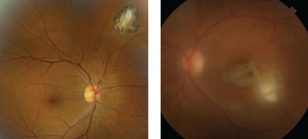 These are the right and left eyes of our patient. What does the hazy view in the left eye represent?