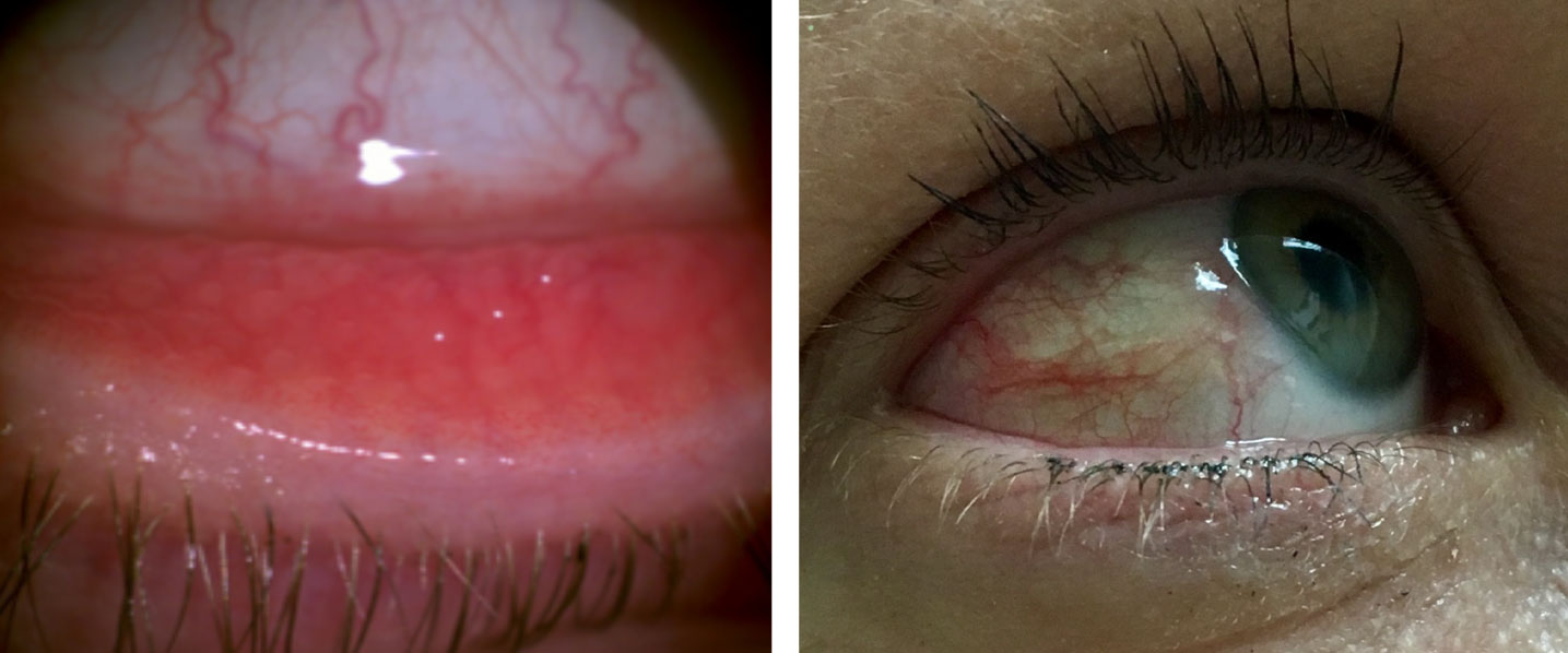 Allergic conjunctivitis can present with bulbar and palpebral conjunctival hyperemia.