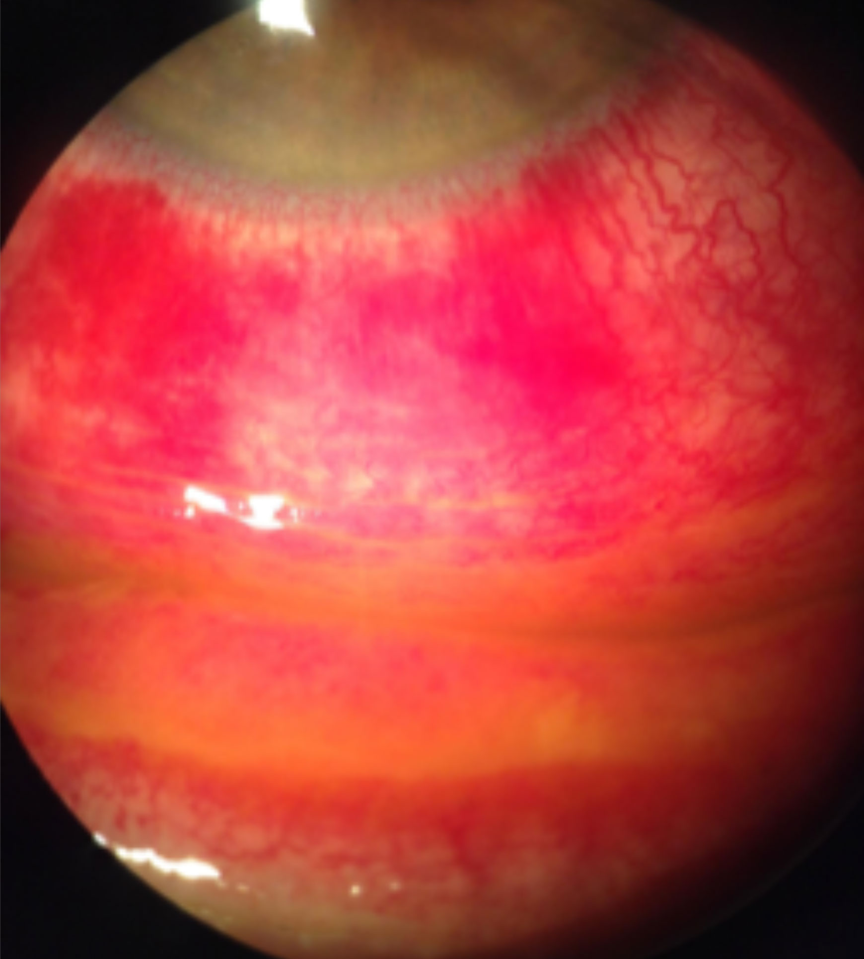 Staining with fluorescein sodium reveals diffuse conjunctival hyperemia associated with a viral infection causing severe inflammation, subconjunctival hemorrhages and pseudomembranes.