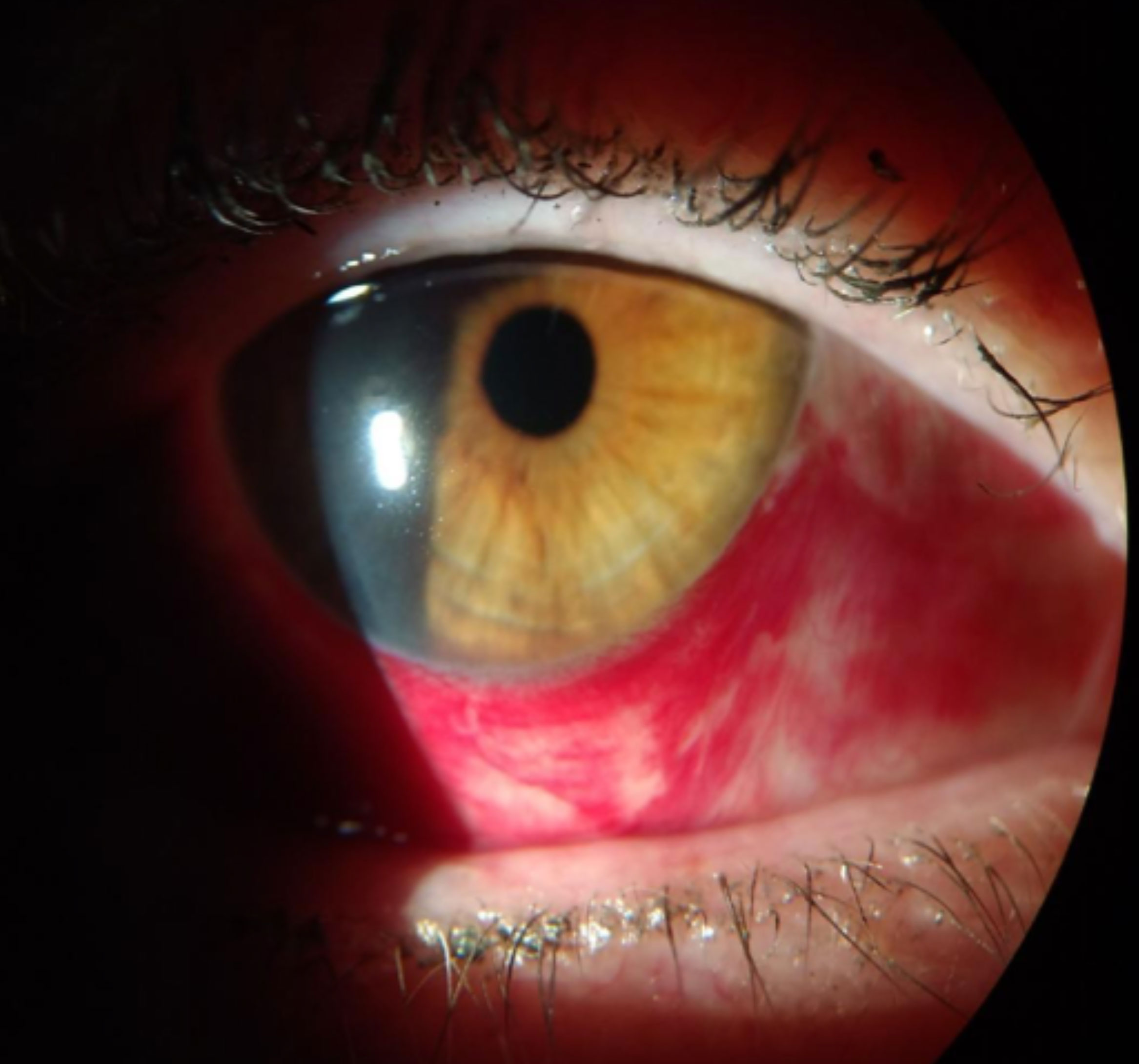 Redness associated with a subconjunctival hemorrhage.