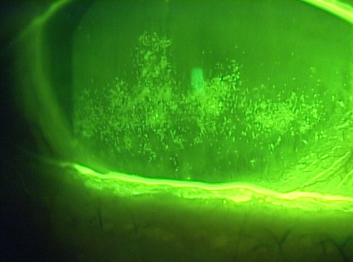 Dry eye patients with confluent superficial punctate keratitis may need an arsenal of rescue therapy options. 