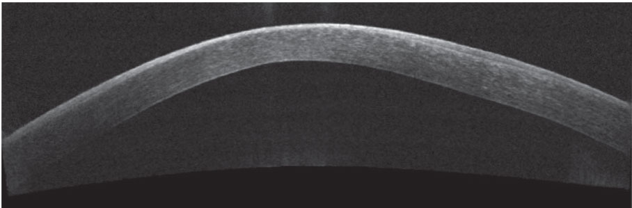 Corneal thinning and bulging are characteristic of KCN.