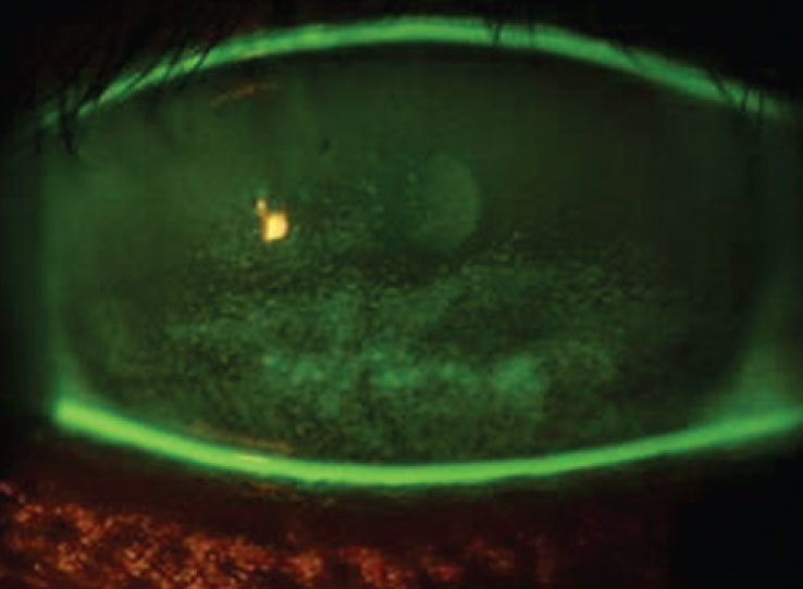Sodium fluorescein staining in a patient with dry eye and exposure keratopathy. Patients with severe dry eye may do better with a viscous artificial tear, gel or ointment.