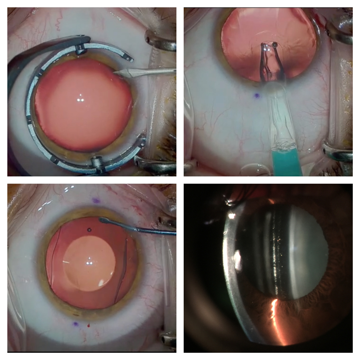 A small opening (top left) is created, and the ICL is inserted into the sulcus (top right) and centered (bottom left). ICL vault over the crystalline lens is evaluated (bottom right).