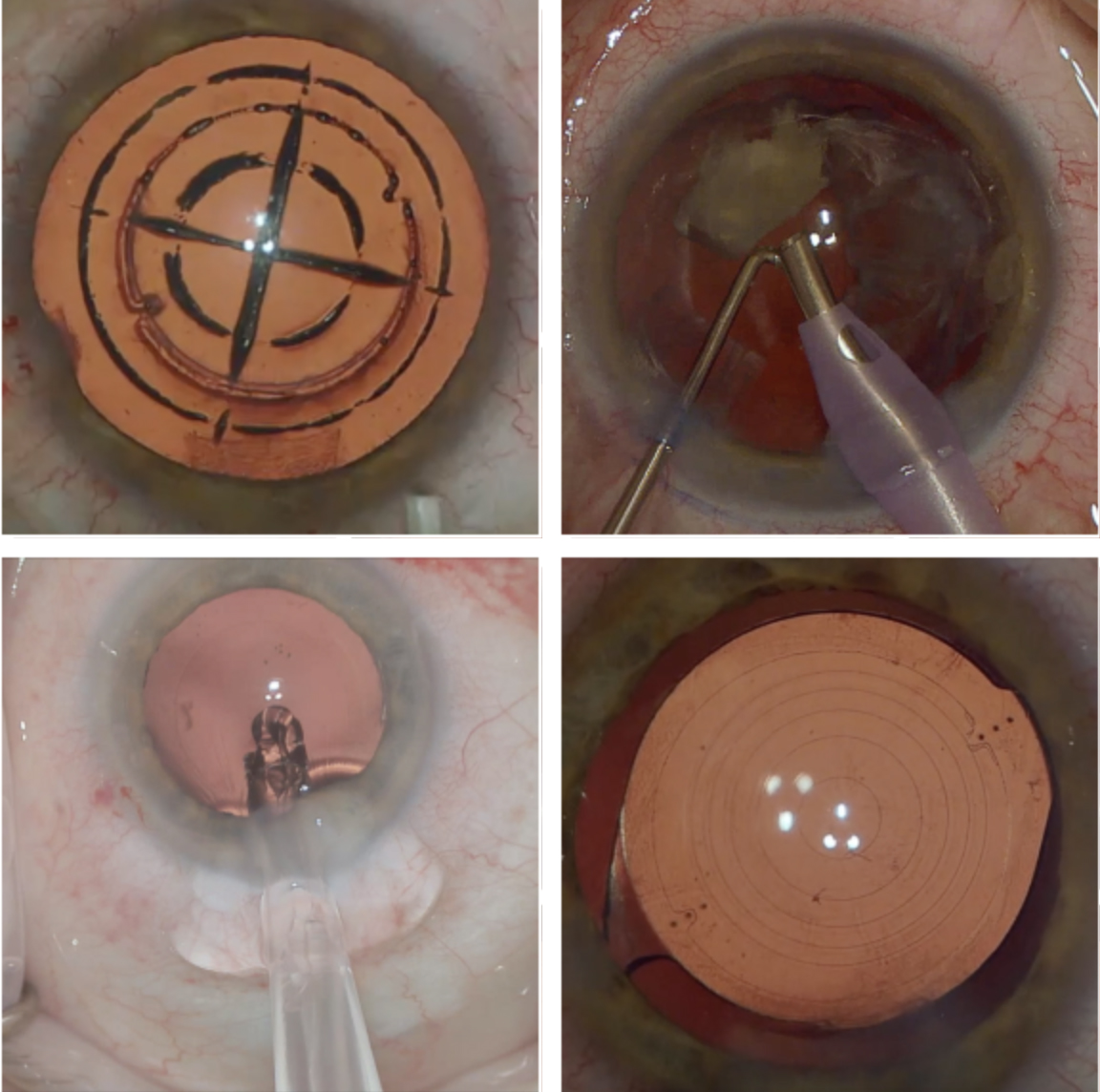 RLE uses a femtosecond laser to soften the lens, create the anterior capsulotomy and create astigmatic keratotomies to correct astigmatism (top left). The cataract or lens is removed by phacoemulsification (top right), and a new lens is inserted (bottom left). Toric IOL placement is evaluated post-op (bottom right).