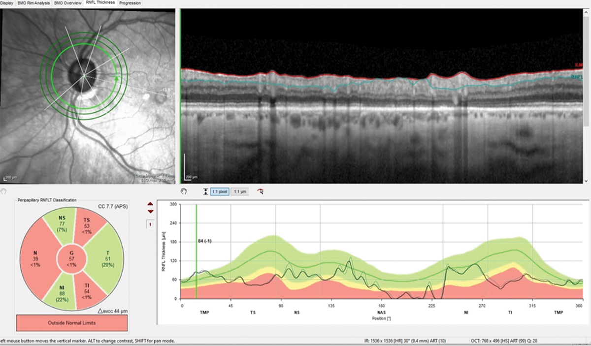 The 3.50mm diameter RNFL scan demonstrates classic superotemporal and inferotemporal RNFL thinning in the left eye. Note the lack of change from baseline (gray).