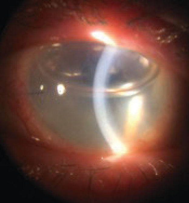 Fig 3. Post-EK, the surgeon will fill the anterior chamber with air to keep the graft adherent to the host cornea.