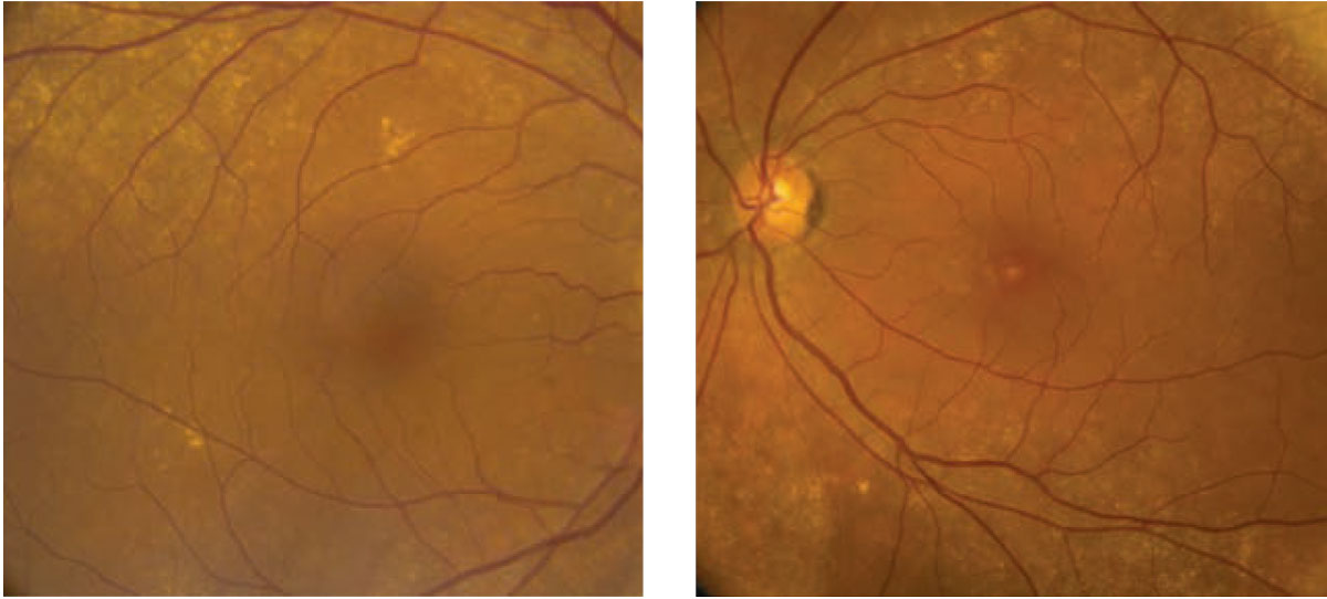 Fig. 1. This is a fundus photograph of the right and left eyes of our patient. Note the macular appearance of the left eye.